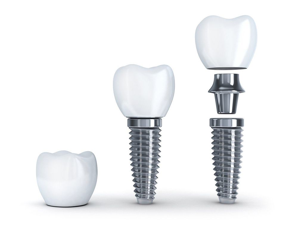 List of Reasons for Getting Dental Implant